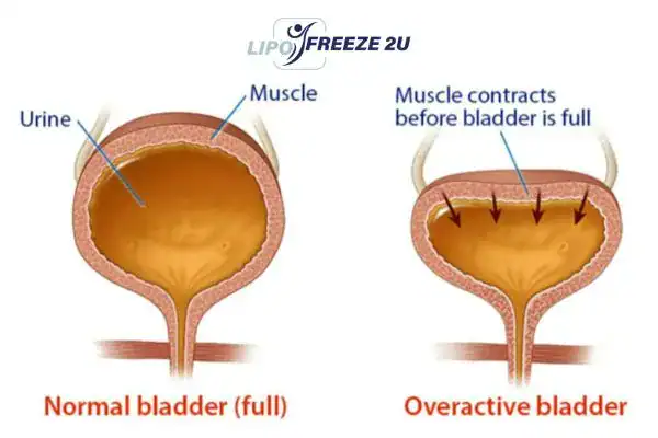 diagram of overactive bladder treatment South Woodford