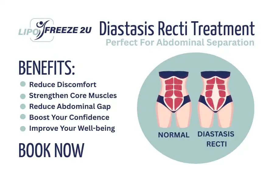 Benefits of body toning treatment South Woodford for Diastasis recti