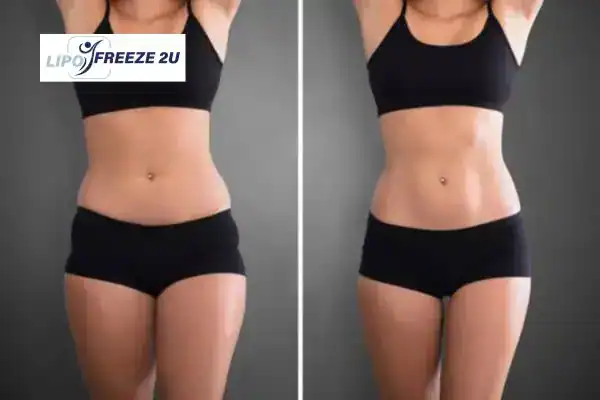 How Can LIPO FREEZE 2U Support Your Post-Pregnancy Body Recovery South Woodford?