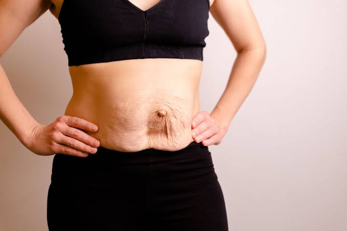 Is Surgery Really the Only Way to Repair Diastasis Recti South Woodford?