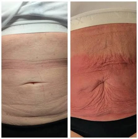 How Does RF Microneedling Improve Crepey, Thin and Uneven Skin Texture South Woodford?
