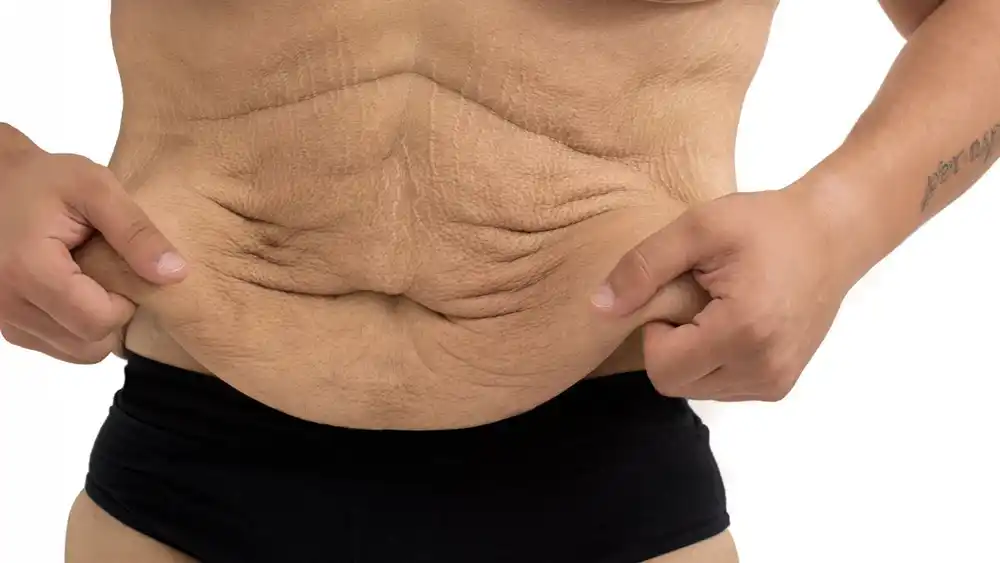 RF Microneedling for Loose Skin: How Can It Help Tighten and Reshape the Skin South Woodford?